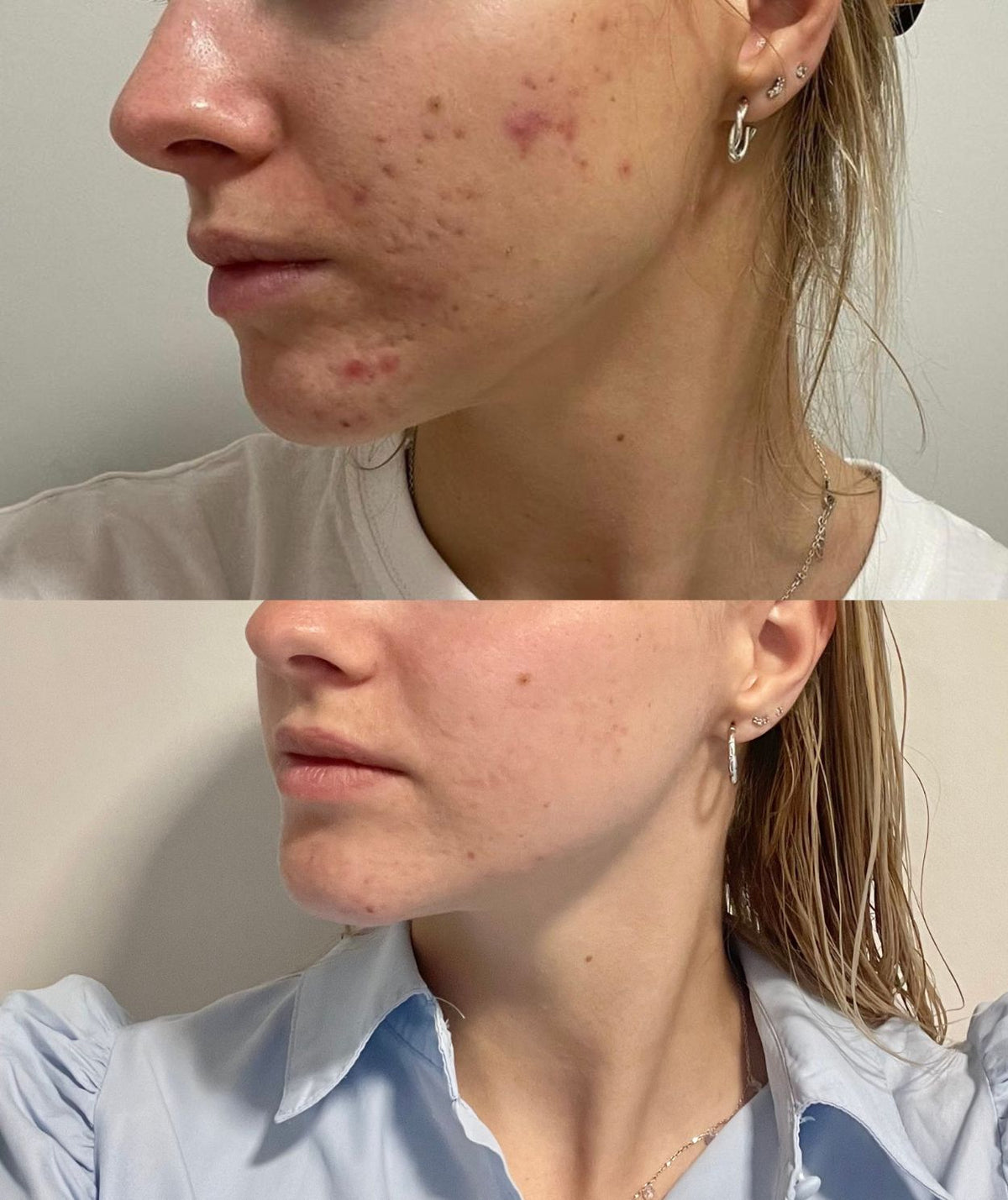 Wasgel voor Acnegevoelige Huid