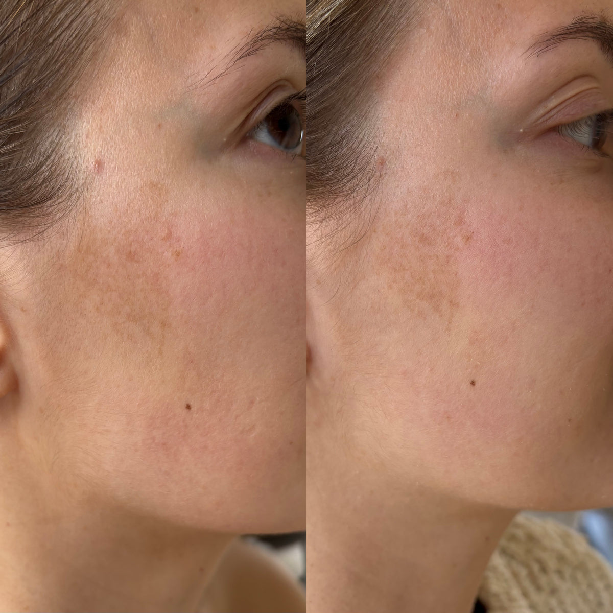 Anti-Pigmentvlekken Serum